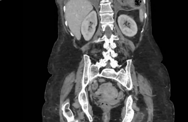 Laparoscopic reduction of transverse colon and greater omentum from left chest, repair of giant para conduit/diaphragmatic hernia with mesh and colonopexy