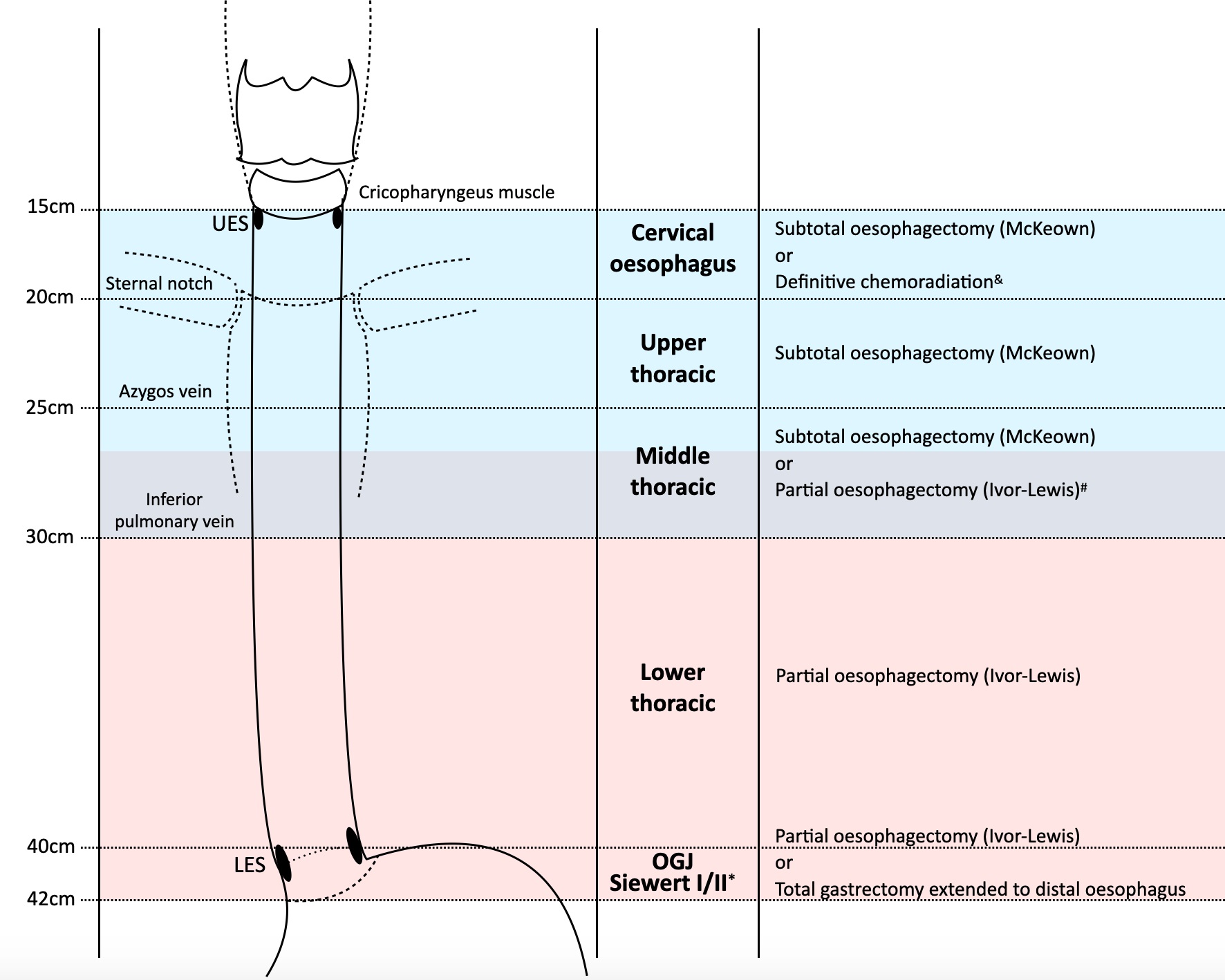 The management of oesophageal cancer: the surgeon’s perspective