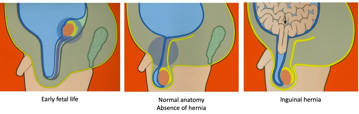 Guest blog in plain English: Hernias in children