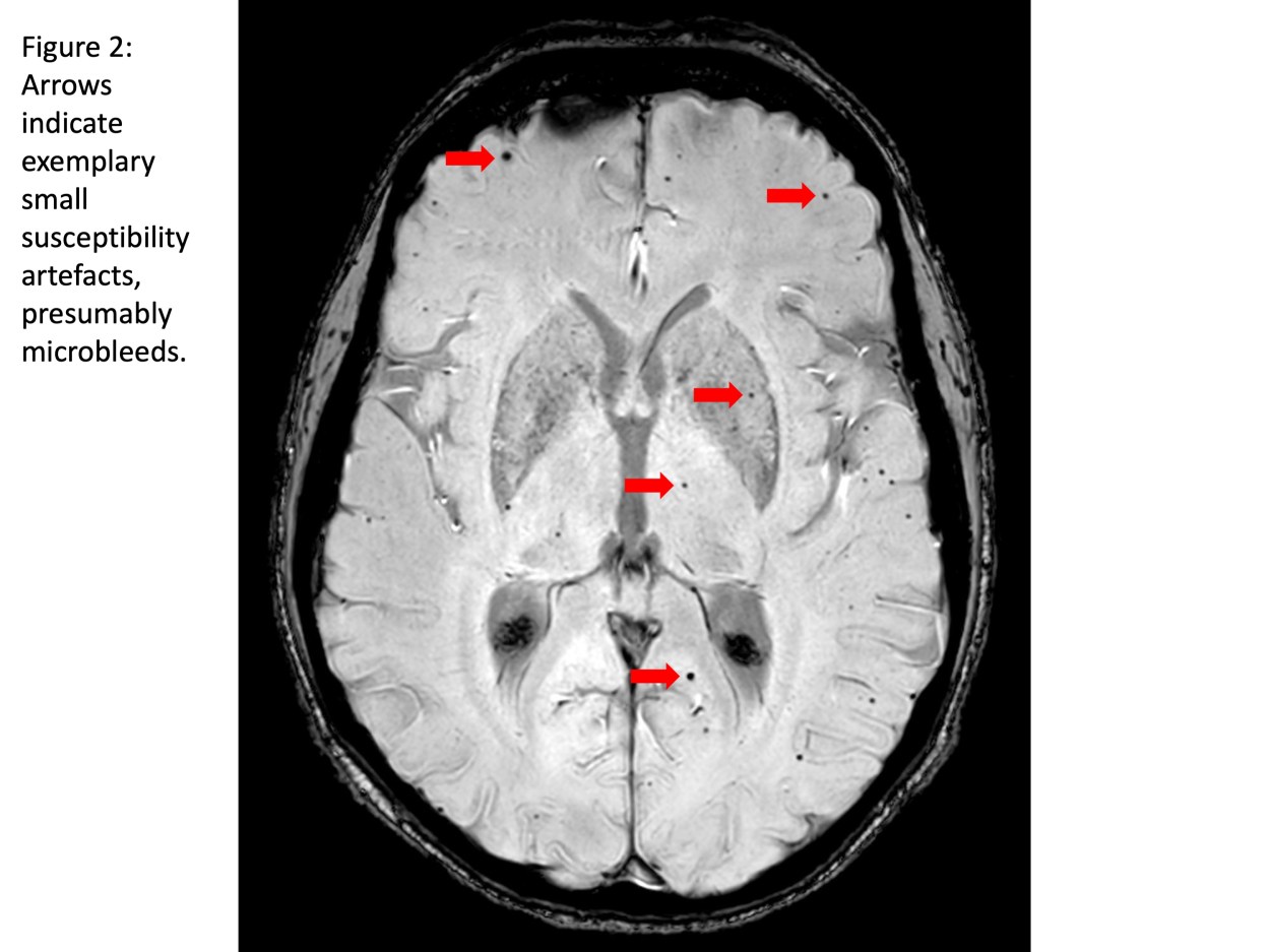 Guest blog: Cerebral microbleeds following thoracic endovascular aortic repair