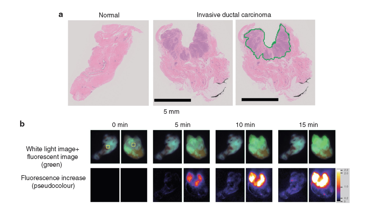 Guest blog: a novel fluorescence technique for detecting breast cancer