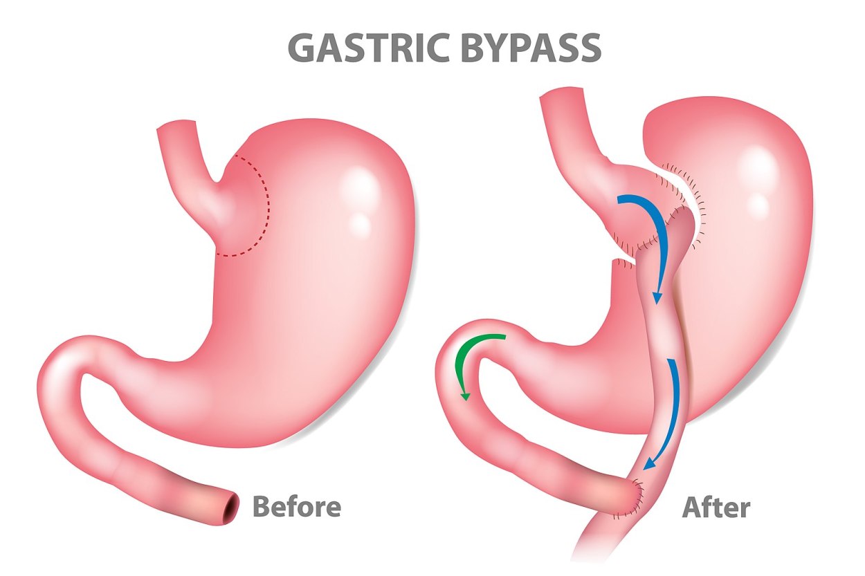 Guest blog: Bariatric Surgery – the safe solution to the metabolic pandemic